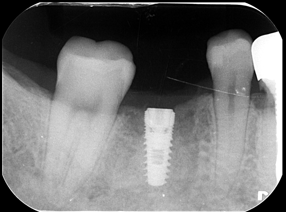 インプラント術後
